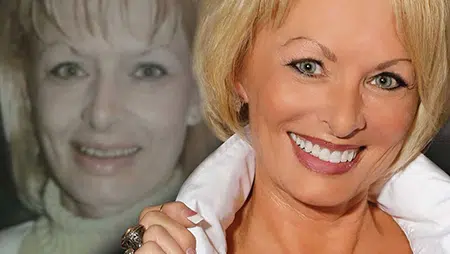 Smile Lift procedure in Plano