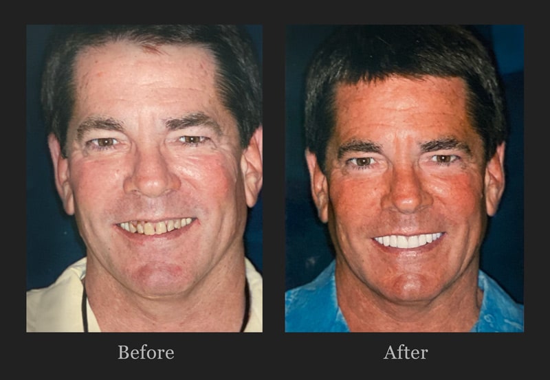 SmileLift before and after pictures Plano