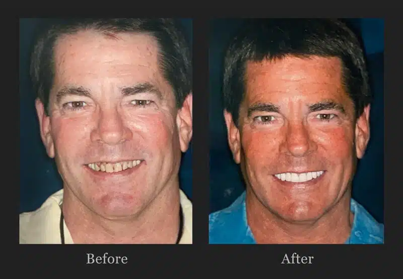 before and after SmileLift Plano