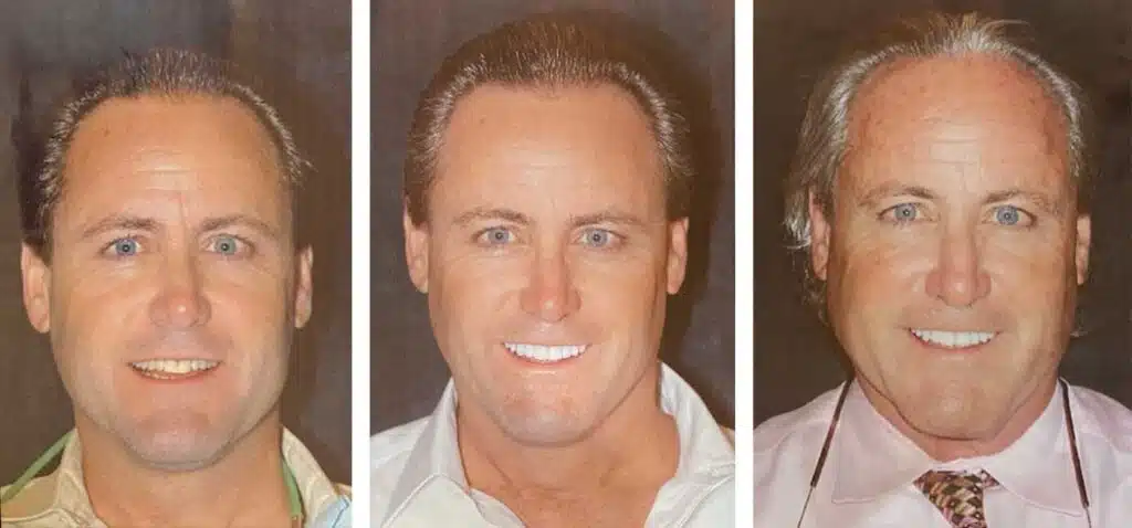 Porcelain Veneer Smile Lift In Richardson