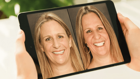 Plano TX Trial Smile Tech Try Many Smiles