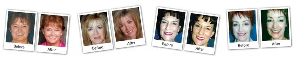 before after Power Of A Smile Plano TX