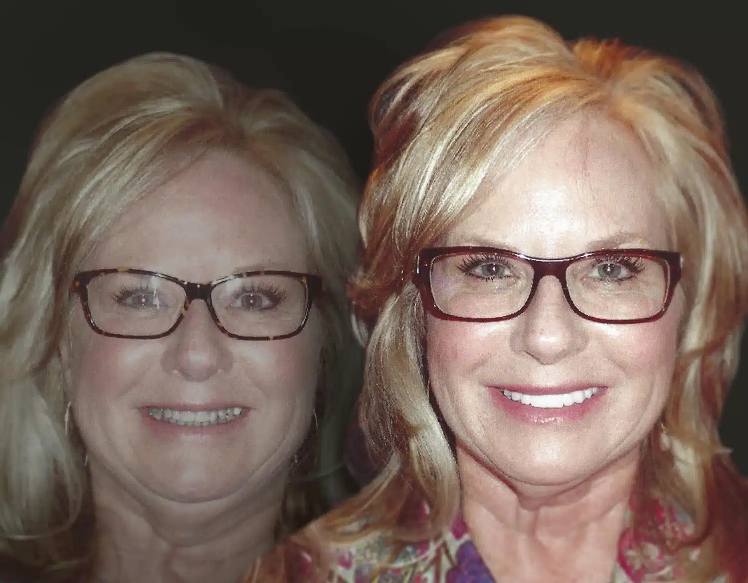 Smile Redesign Dallas Cosmetic Dentist