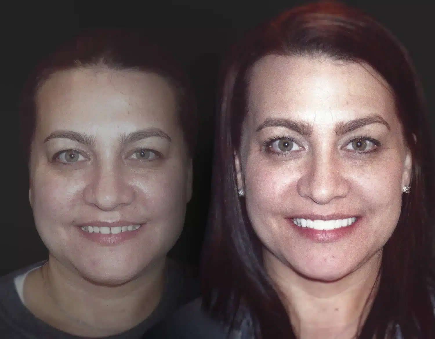 Cosmetic Dental Procedures Dallas