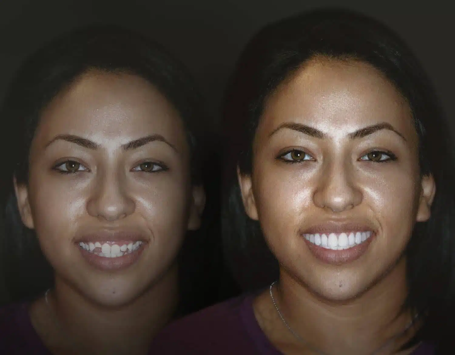 Smile Transformation - Plano Cosmetic Dentist