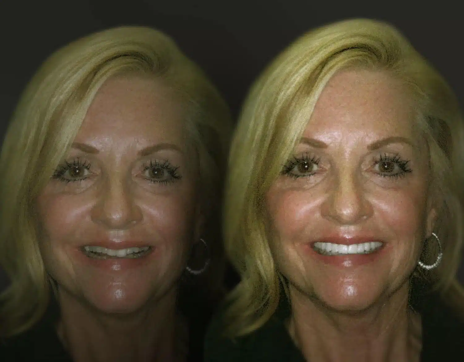 Before and After - Dallas Cosmetic Dentistry