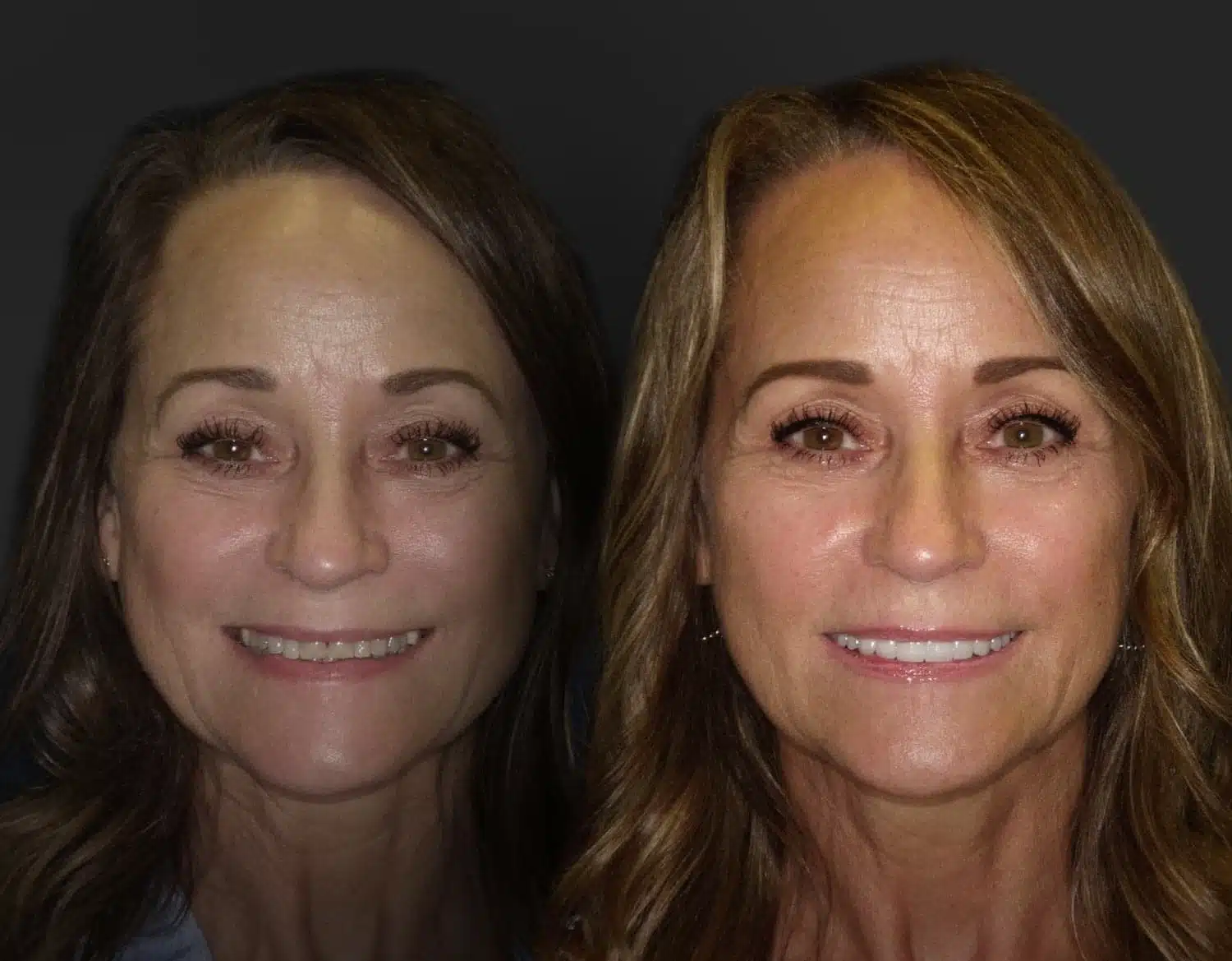Before and After - Cosmetic Dentistry Plano TX