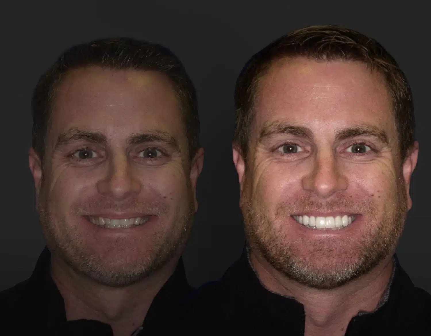 Joseph Before and After - Dallas Smile Makeover