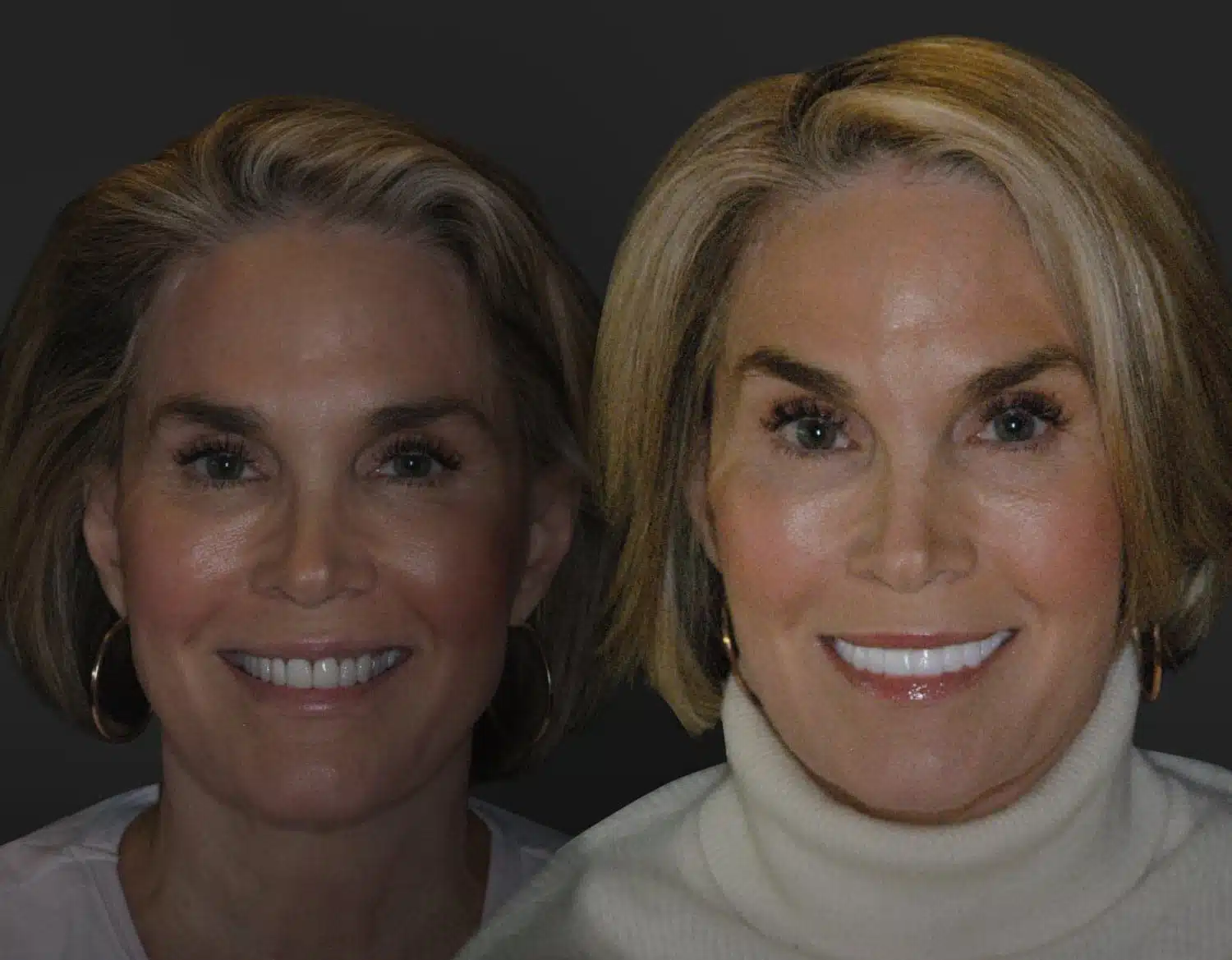 Dane Before and After - Plano Cosmetic Dentist