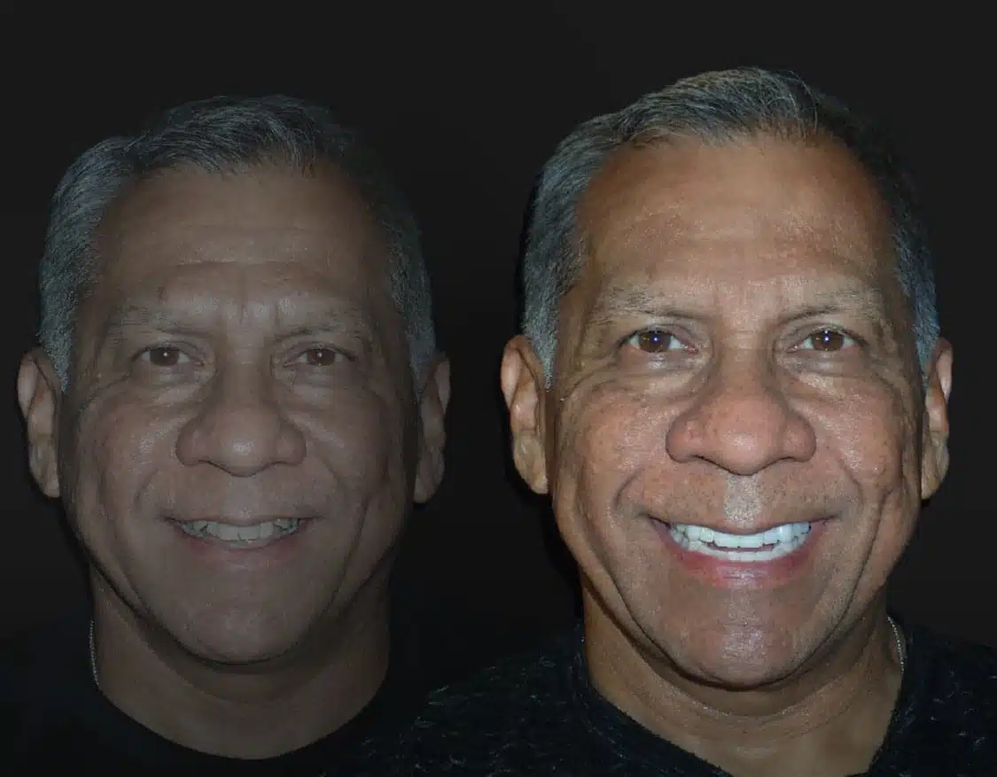 Mac Before and After - Dallas Cosmetic Dentist