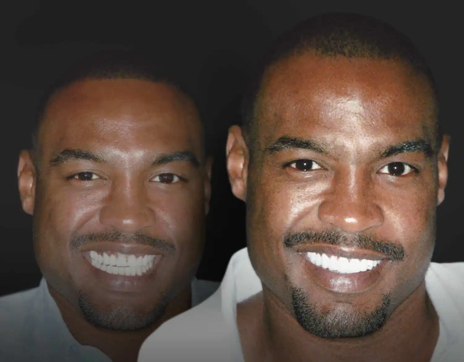 Smile Makeover Before After - Plano TX