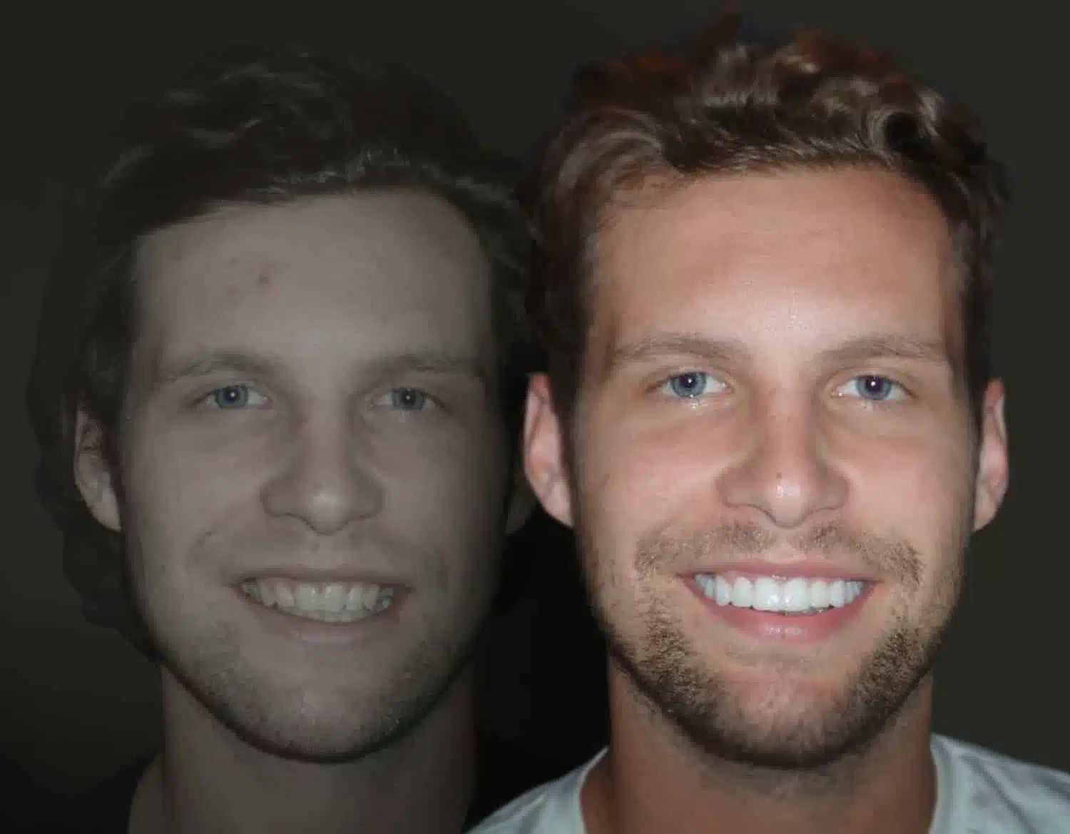 Smile Enhancement Dallas Plano