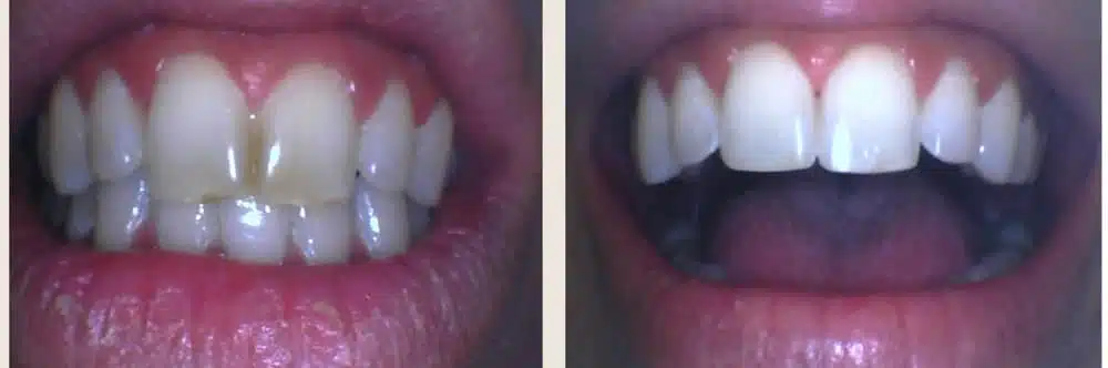 Before & After Dental Cleaning