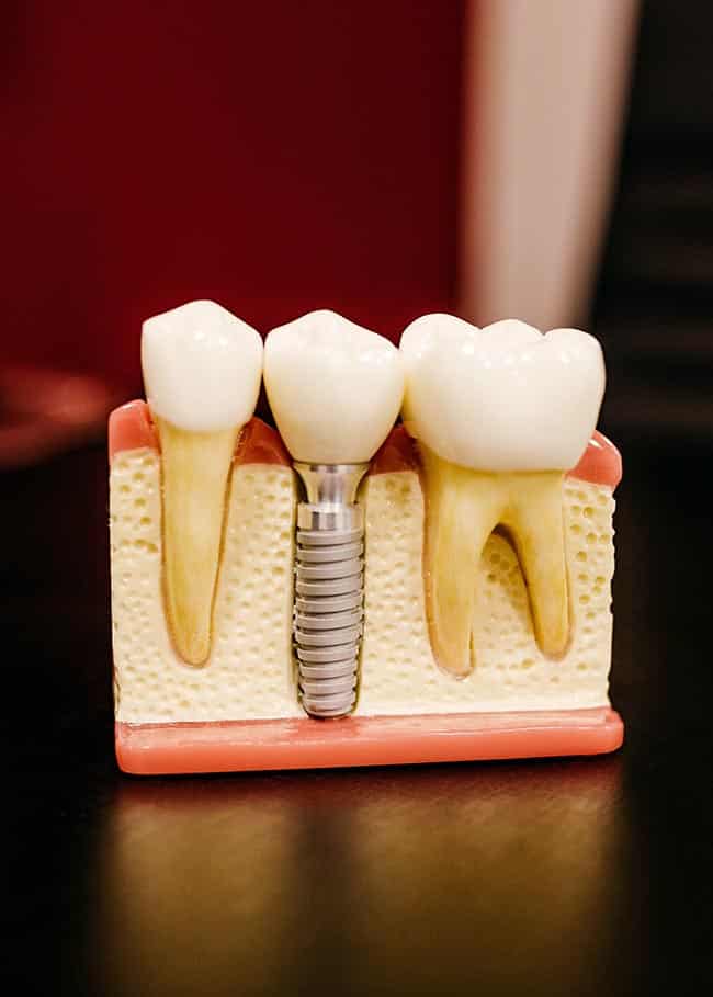 Revolutionizing Smiles: A Comprehensive Guide to Dental Implants 65e236b63b9a1.jpeg