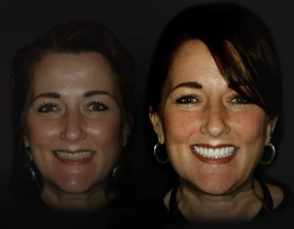 Tricia Before and After - Cosmetic Dentistry Dallas