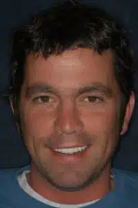 After Image: Smile Makeover