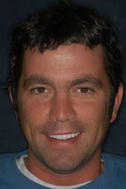 After Image: Smile Makeover - front