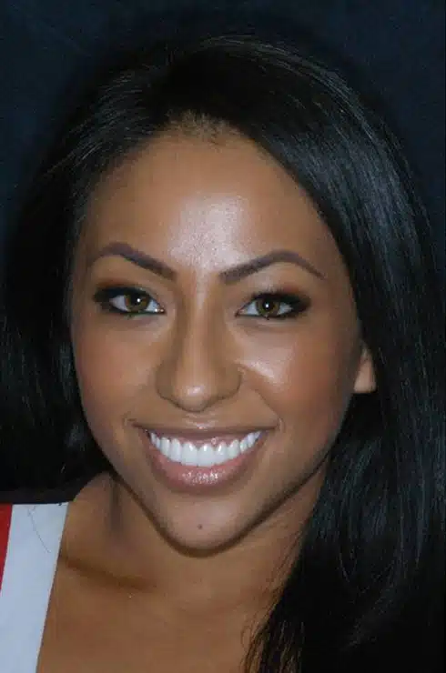 After Image: Smile Makeover - front