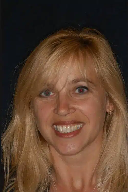 Before Image: Smile Makeover - front