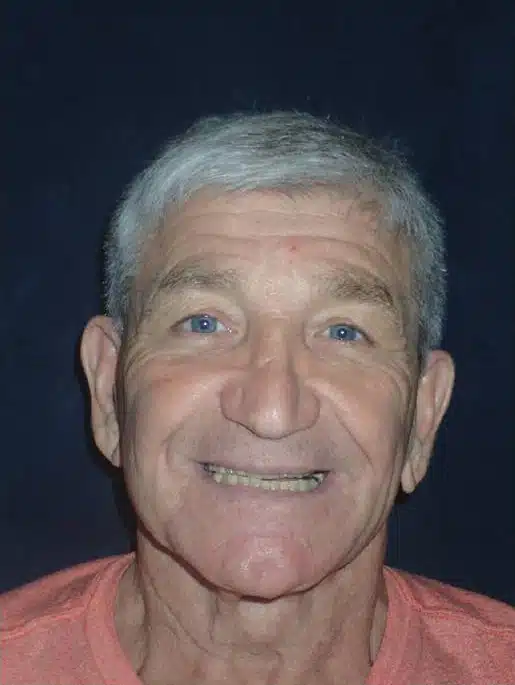 Before Image: Smile Makeover - front