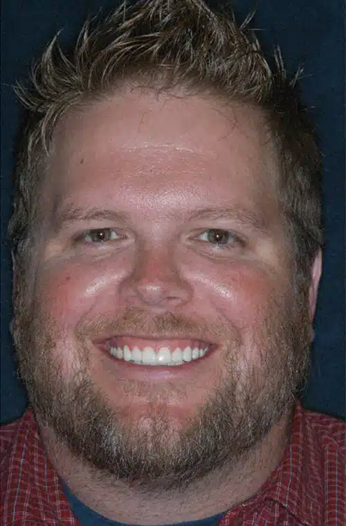 After Image: Smile Makeover - front