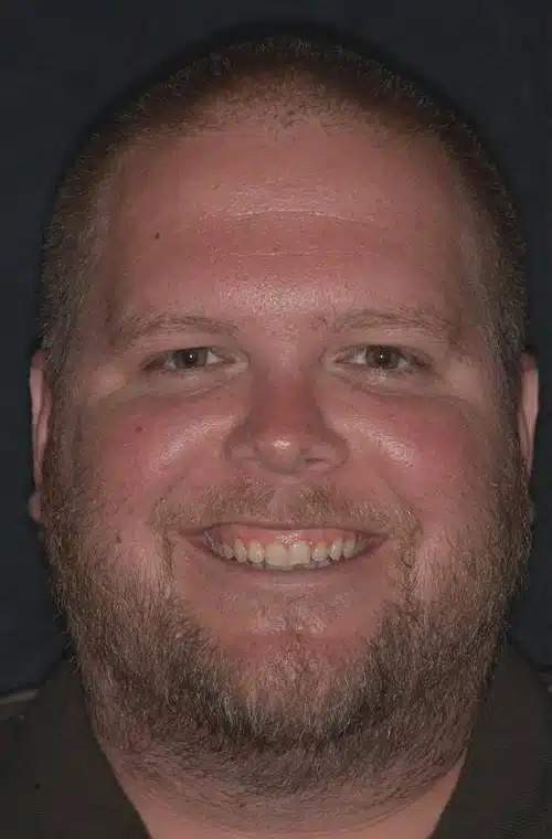 Before Image: Smile Makeover - front