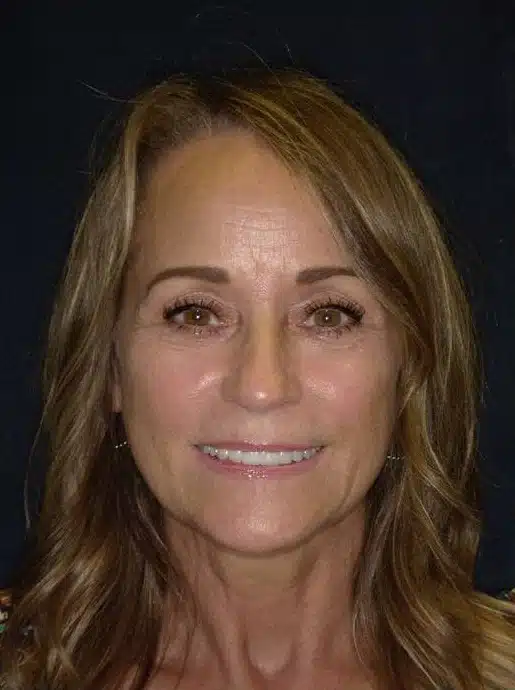 After Image: Smile Makeover - front