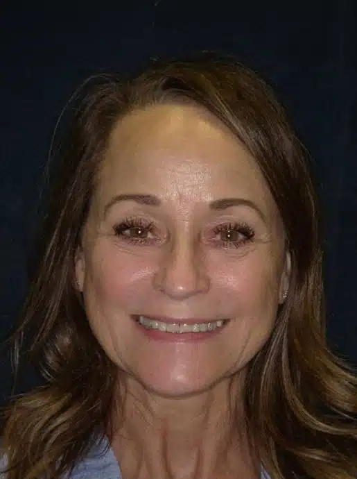 Before Image: Smile Makeover - front