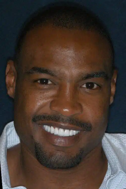 After Image: Smile Makeover - front