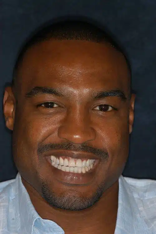 Before Image: Smile Makeover - front