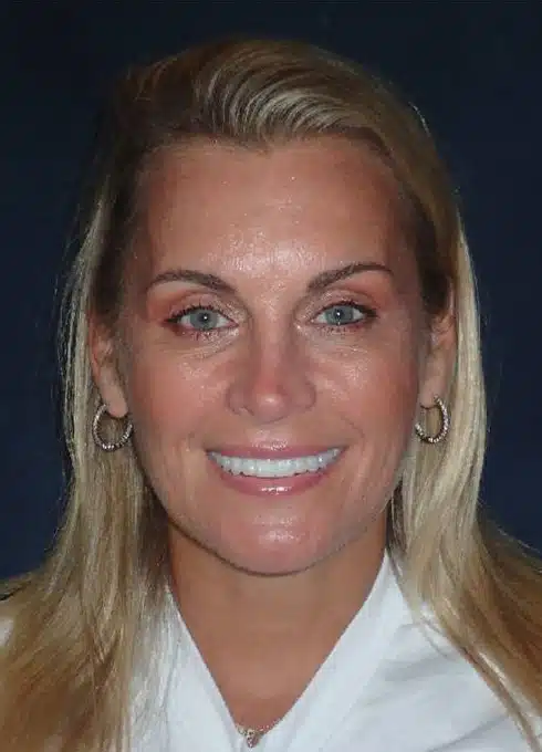 After Image: Smile Makeover - front