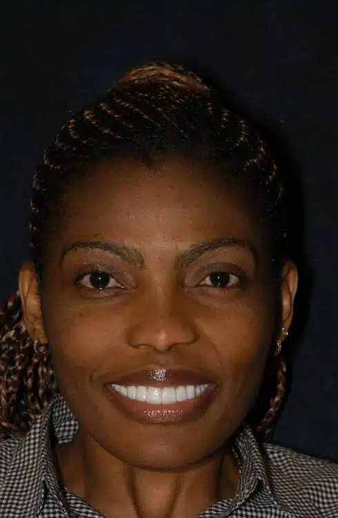 After Image: Smile Makeover - front
