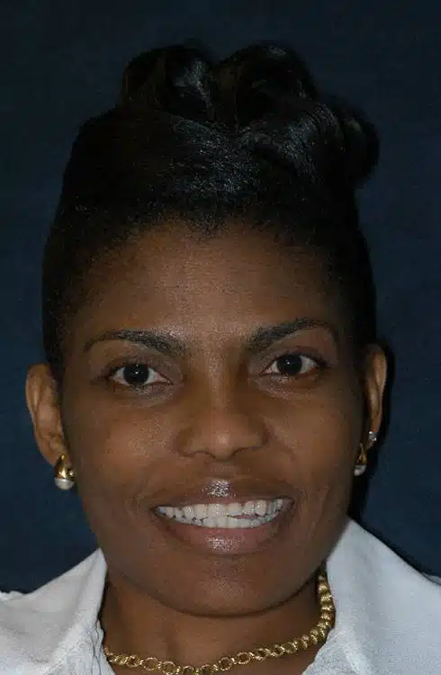 Before Image: Smile Makeover - front