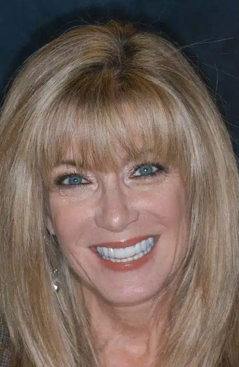 After Image: Smile Makeover - front