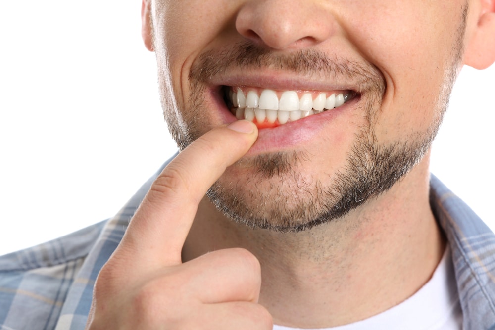 A close-up shot of a man’s teeth and gums