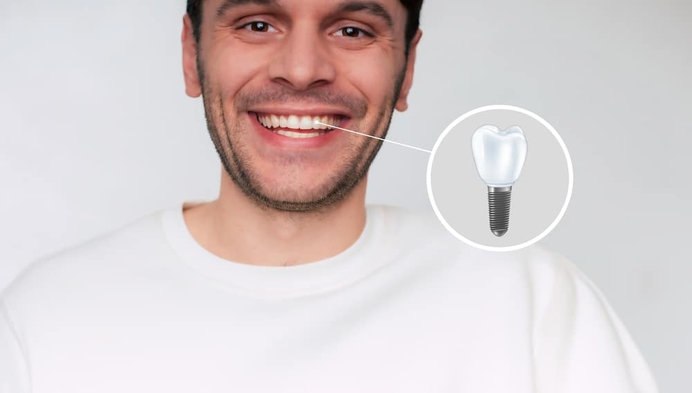 Why It's Important to Replace a Missing Tooth As Soon As Possible Man smiles showing a complete smile after replacing a missing tooth with a dental implant.