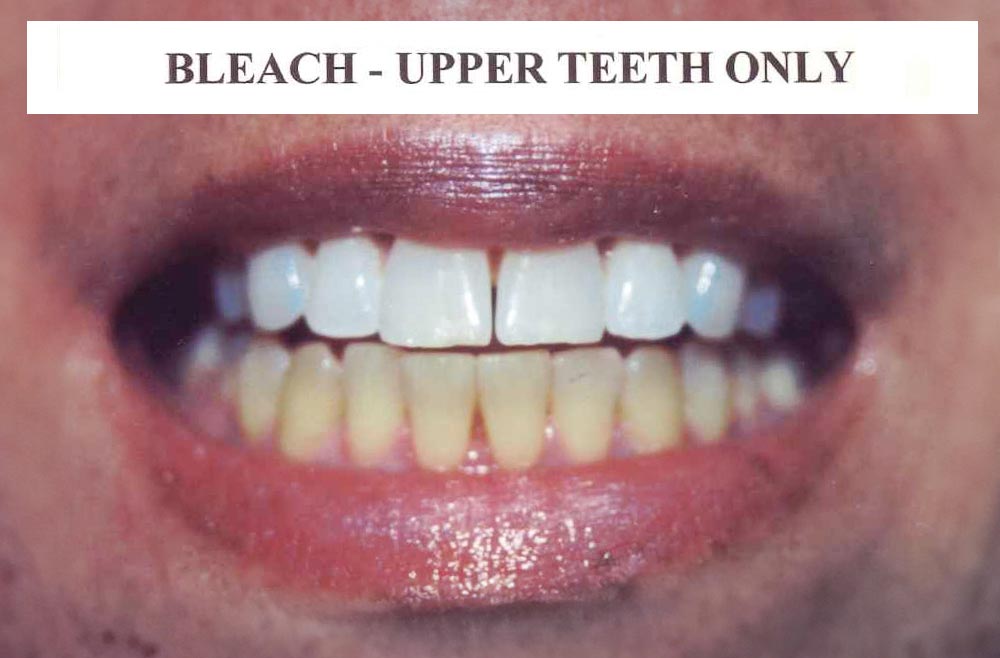 bleach upperteeth