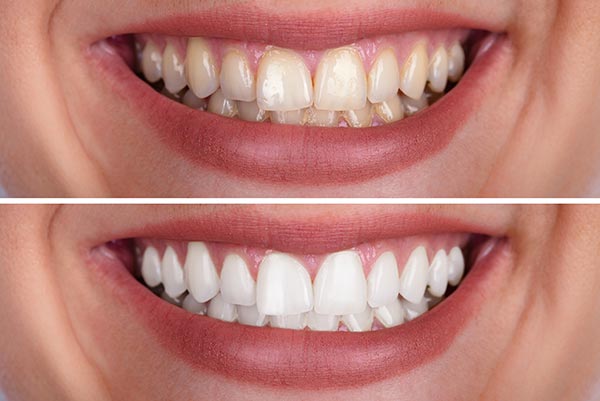 teeth whitening