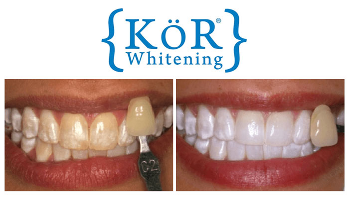kor whitening