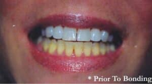 Take-Home Teeth Whitening in Plano – Smile Maker of Texas