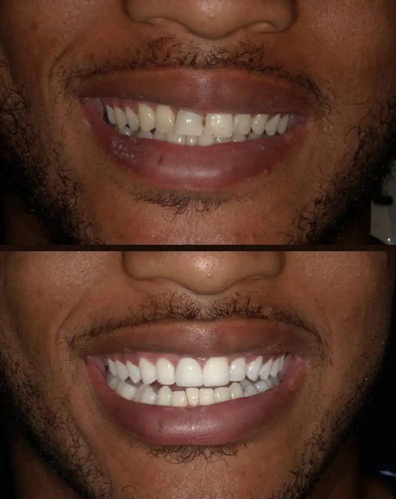 Teeth Whitening at Smile Maker of Texas