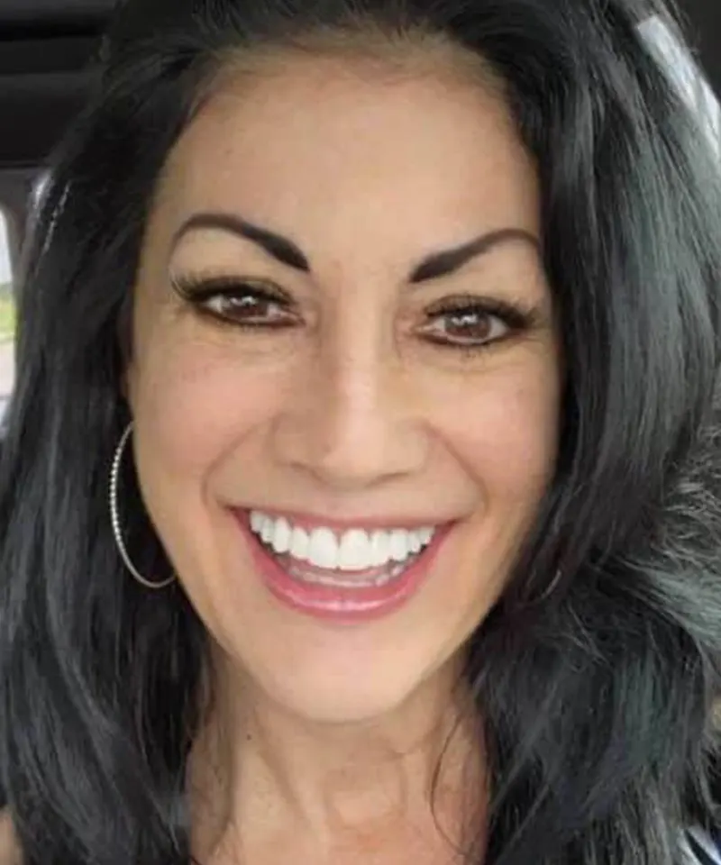 After complete smile transformation — SmileLift plus dental implants, Carrollton TX