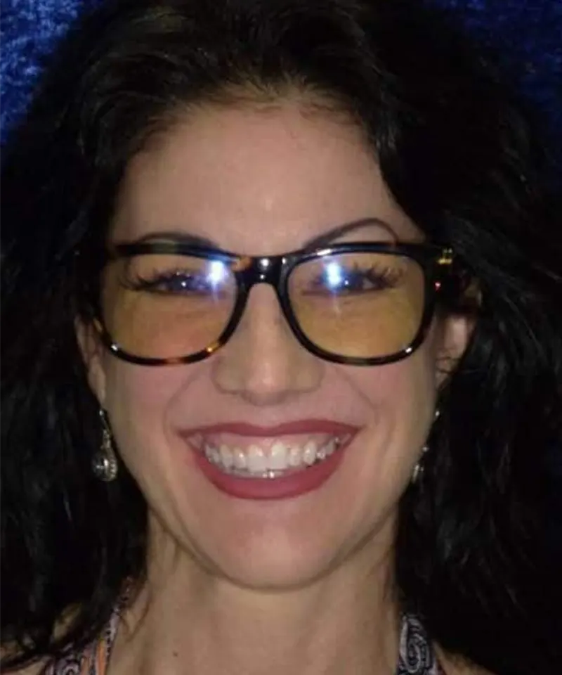 Before complete smile transformation — SmileLift and implants, Carrollton TX patient