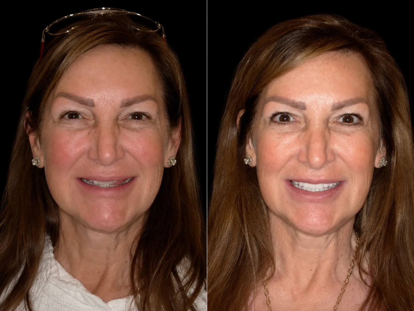 Before and after smile makeover by Dallas cosmetic dentist Dr. Ritchie Beougher — SmileLift™ at Smile Maker of Texas, Plano