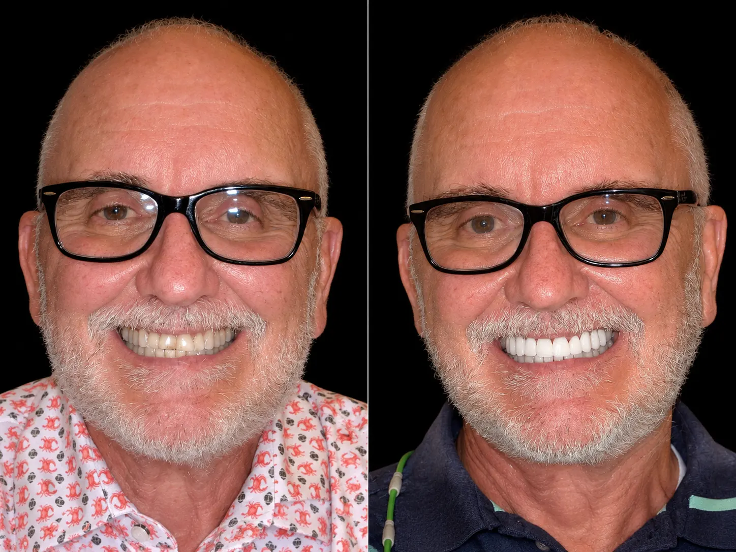Before and after smile makeover by Dallas cosmetic dentist Dr. Ritchie Beougher — SmileLift™ at Smile Maker of Texas, Plano