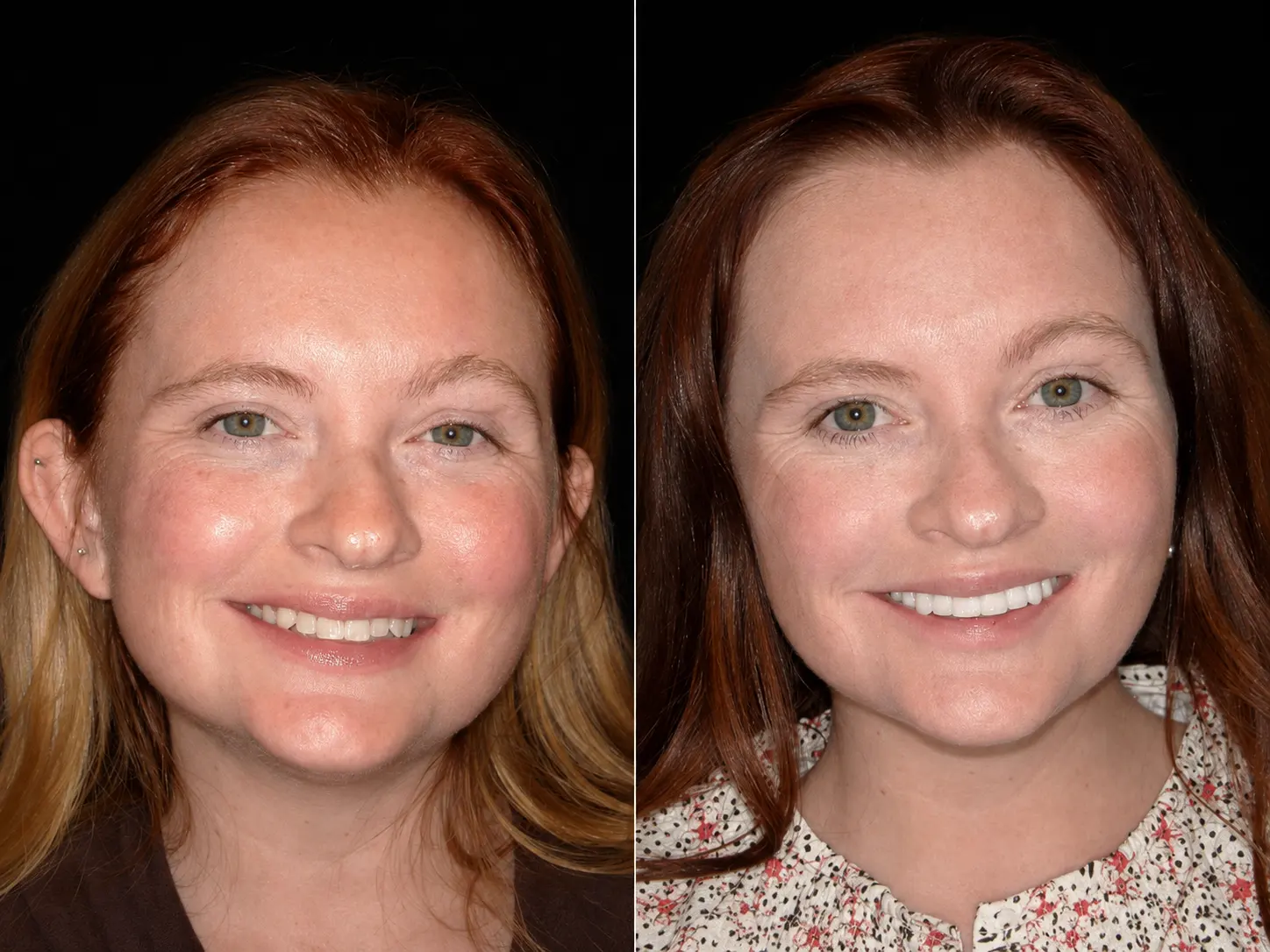 Before and after smile makeover by Dallas cosmetic dentist Dr. Ritchie Beougher — SmileLift™ at Smile Maker of Texas, Plano