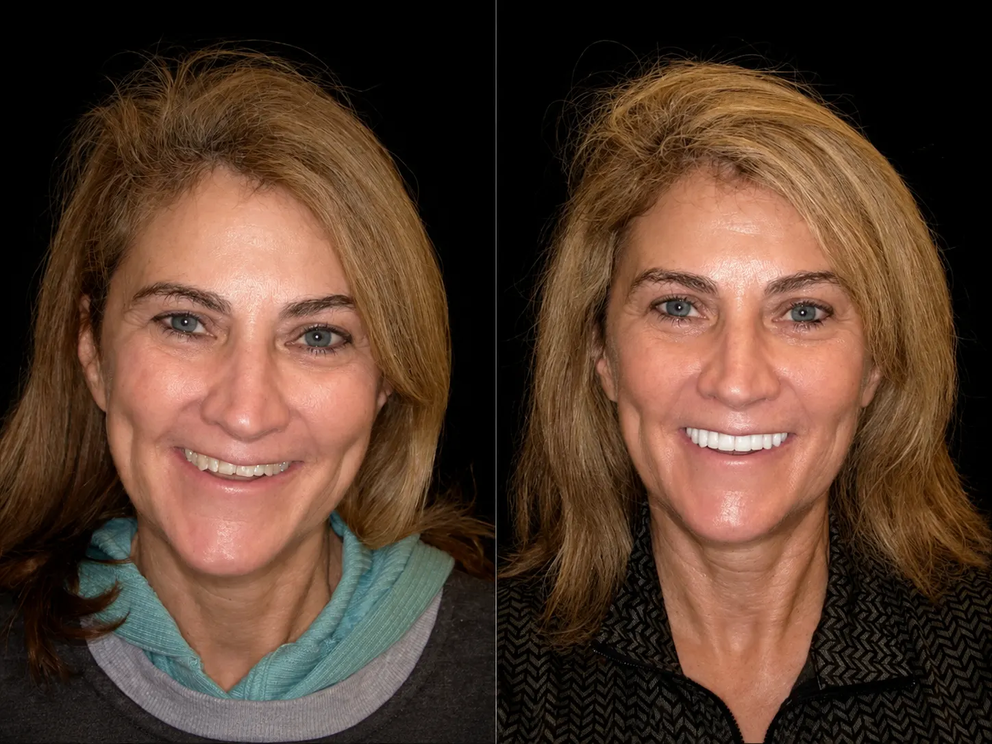 Before and after smile makeover by Dallas cosmetic dentist Dr. Ritchie Beougher — SmileLift™ at Smile Maker of Texas, Plano