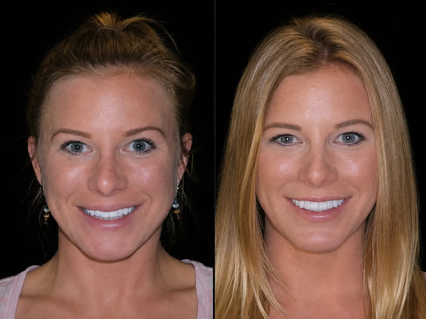 Before and after smile makeover by Dallas cosmetic dentist Dr. Ritchie Beougher — SmileLift™ at Smile Maker of Texas, Plano