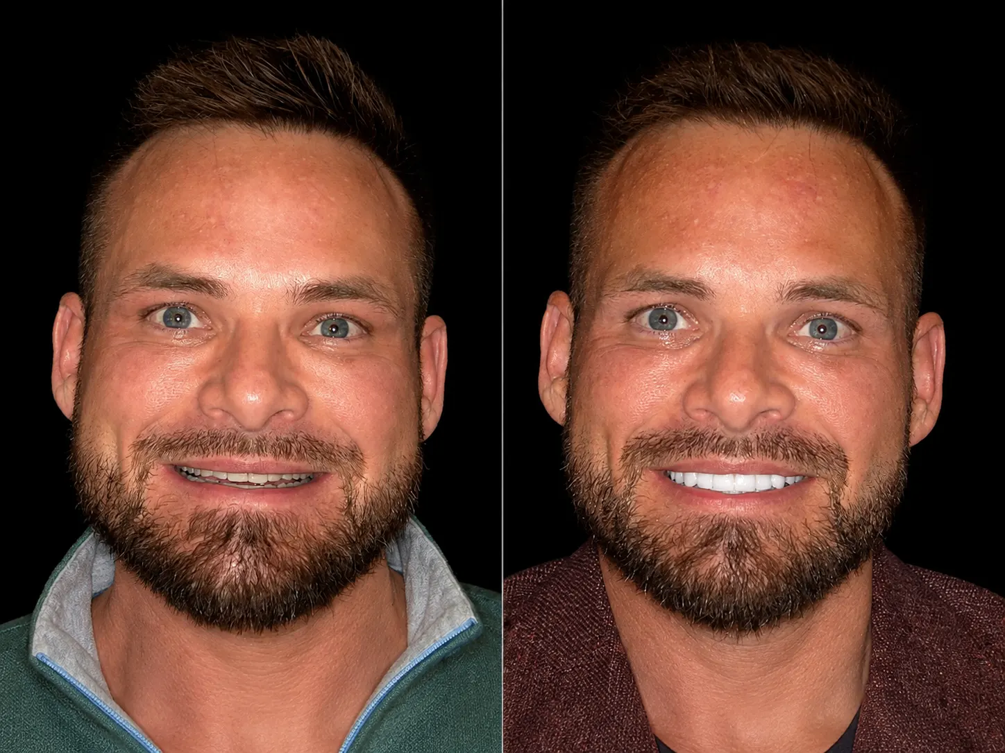 Before and after smile makeover by Dallas cosmetic dentist Dr. Ritchie Beougher — SmileLift™ at Smile Maker of Texas, Plano