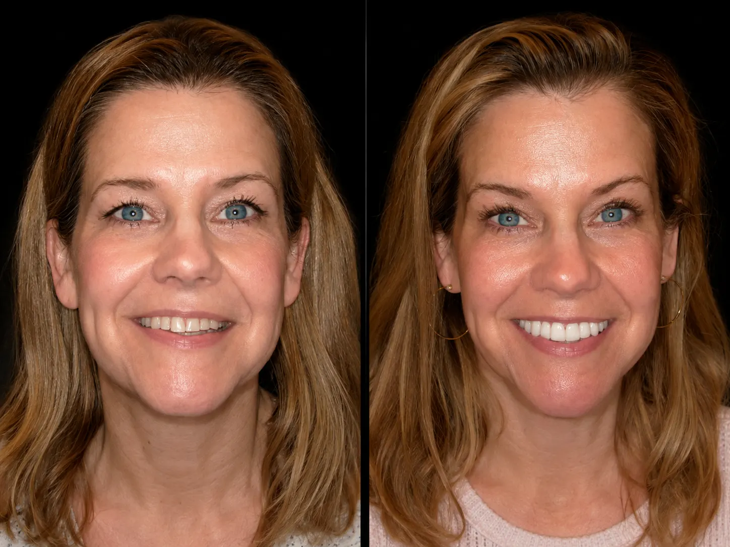 Before and after smile makeover by Dallas cosmetic dentist Dr. Ritchie Beougher — SmileLift™ at Smile Maker of Texas, Plano
